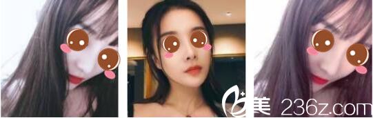 韓國ID整形醫(yī)院鄭承一假體隆鼻真人案例術(shù)后三個月