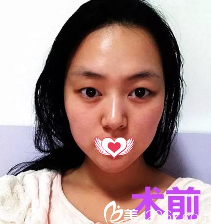 術(shù)前腫泡眼單眼皮 術(shù)前腫泡眼單眼皮