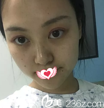 切開雙眼皮3天后眼睛紅腫 切開雙眼皮3天后眼睛紅腫