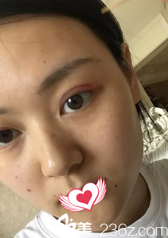 術(shù)后7天雙眼皮拆線后微腫 術(shù)后7天雙眼皮拆線后微腫