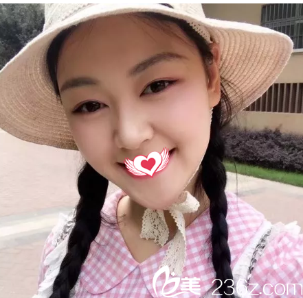 切開雙眼皮16天眼睛消腫 切開雙眼皮16天眼睛消腫