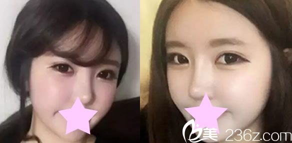 假體隆鼻術(shù)后恢復(fù)圖 假體隆鼻術(shù)后恢復(fù)圖