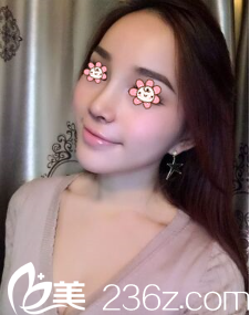 <!--<i data=20240703-sp></i>-->假體隆鼻術(shù)后18天