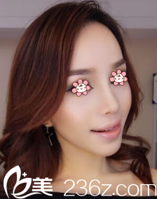 貴陽美貝爾<!--<i data=20240703-sp></i>-->假體隆鼻術(shù)后一個(gè)月