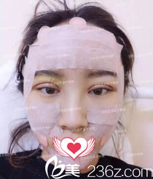 雙眼皮+自體脂肪填充全臉術(shù)后即刻效果