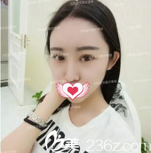 在沈陽(yáng)藍(lán)天整形醫(yī)院一口氣做了雙眼皮+自體脂肪填充全臉后效果竟然超出我的意料！