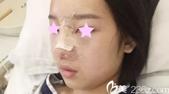 韓美鼻綜合隆鼻天