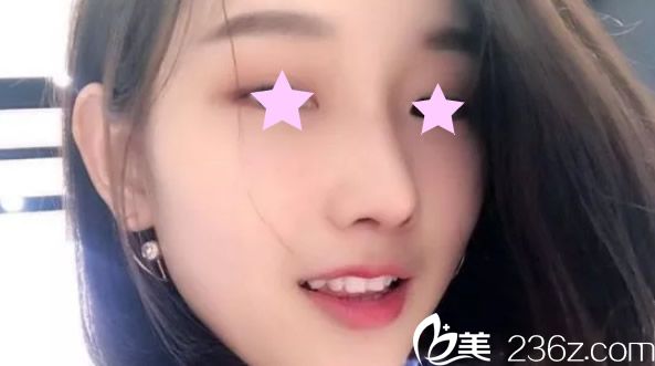 韓式生科隆鼻+耳軟骨墊鼻尖第20天效果