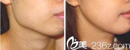 下頜角整形前后對(duì)比效果 下頜角整形前后對(duì)比效果