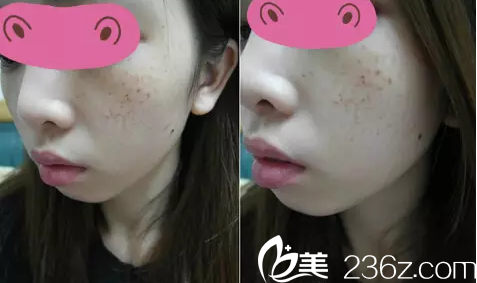 韓國(guó)韓美人祛斑第8天樣子 韓國(guó)韓美人祛斑第8天樣子