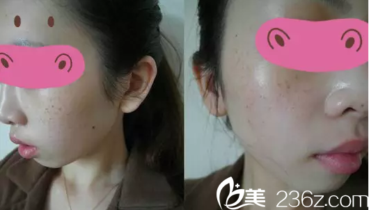 韓國(guó)韓美人祛斑案例 韓國(guó)韓美人祛斑案例