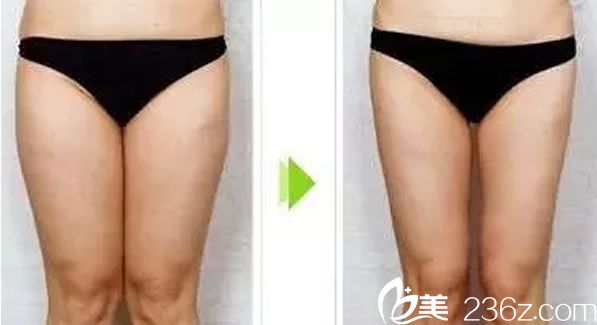蘭州韓美大腿吸脂效果案例