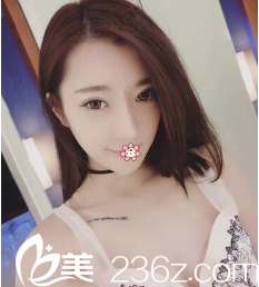 重瞼線消失變一單一雙，幸好韓國(guó)JH整形醫(yī)院南榮午做埋線雙眼皮修復(fù)給我弄好了。