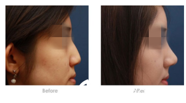 隆鼻前后對比圖