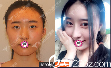 北京潤美玉之光面部脂肪填充雙眼皮 北京潤美玉之光面部脂肪填充雙眼皮