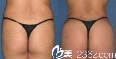 北京潤美玉之光脂肪豐臀 北京潤美玉之光脂肪豐臀