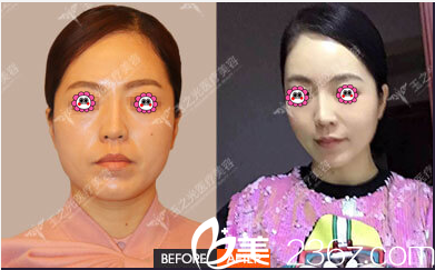 北京潤美玉之光面部吸脂 北京潤美玉之光面部吸脂