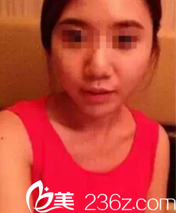 術(shù)前塌鼻子面部凹陷 術(shù)前塌鼻子面部凹陷