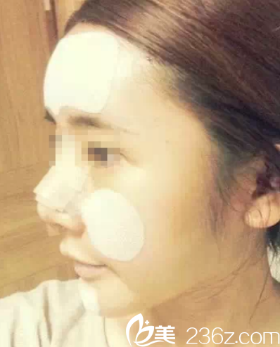 剛做完面部脂肪填充+隆鼻效果 剛做完面部脂肪填充+隆鼻效果