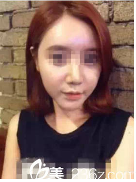 術(shù)后一周鼻子消腫脂肪填充還在恢復(fù) 術(shù)后一周鼻子消腫脂肪填充還在恢復(fù)