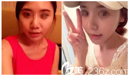 在常州施爾美做脂肪移植+隆鼻術(shù)前術(shù)后對(duì)比 在常州施爾美做脂肪移植+隆鼻術(shù)前術(shù)后對(duì)比