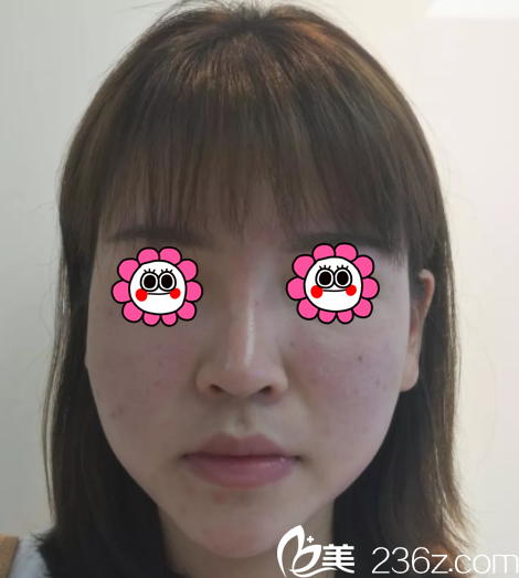 在北京潤美玉之光做面部吸脂前樣子 在北京潤美玉之光做面部吸脂前樣子