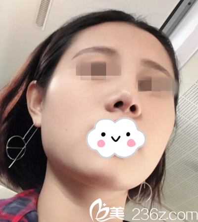 術(shù)后半個(gè)月