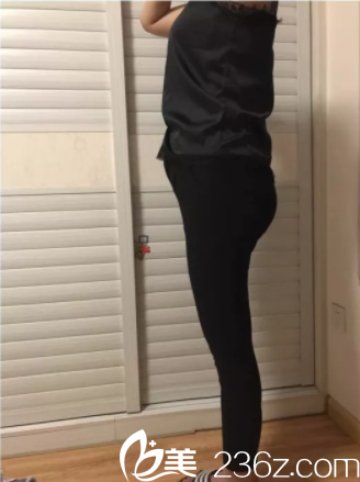 北京潤美玉之光腿部吸脂第16天效果