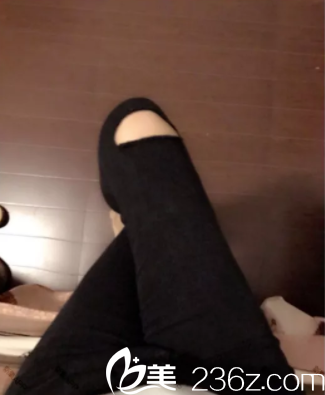 北京潤美玉之光吸脂瘦腿案例