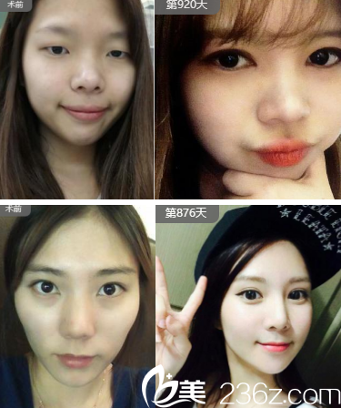 ?？他愓瓮饪漆t(yī)院自體脂肪填充案例