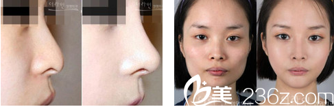 德萊茵整形外科醫(yī)院隆鼻案例