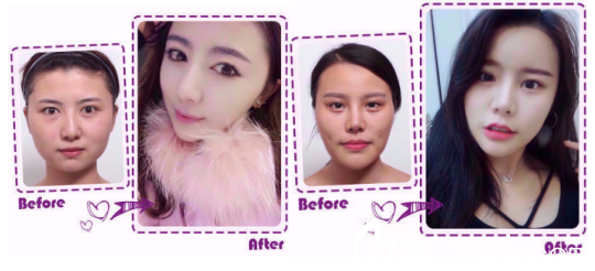 韓國女神整形外科輪廓案例