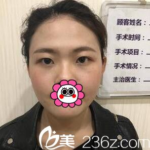 在<!--<i data=20240703-sp></i>-->整形醫(yī)院做3D媚眼綜合手術(shù)術(shù)前照 在<!--<i data=20240703-sp></i>-->整形醫(yī)院做3D媚眼綜合手術(shù)術(shù)前照