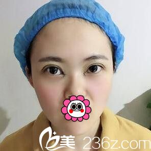 3D媚眼綜合手術(shù)術(shù)后即刻效果 3D媚眼綜合手術(shù)術(shù)后即刻效果