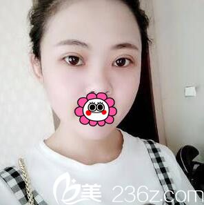 蔣新力做的3D媚眼綜合手術(shù)術(shù)后半個月恢復(fù)效果 蔣新力做的3D媚眼綜合手術(shù)術(shù)后半個月恢復(fù)效果