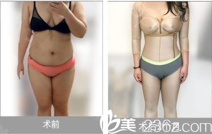 脂肪移植術(shù)案例 脂肪移植術(shù)案例