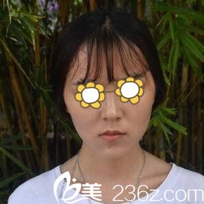 在韓國做下頜角術(shù)前照 在韓國做下頜角術(shù)前照