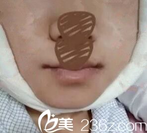 下頜角整形術(shù)后第二天效果 下頜角整形術(shù)后第二天效果