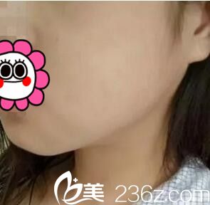 下頜角整形術(shù)后一周恢復(fù)程度 下頜角整形術(shù)后一周恢復(fù)程度