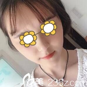 在韓國首爾整形外科做下頜角術(shù)后半個月效果 在韓國首爾整形外科做下頜角術(shù)后半個月效果