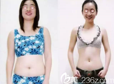 鄭鎬勛院長(zhǎng)腰腹部吸脂案例 鄭鎬勛院長(zhǎng)腰腹部吸脂案例