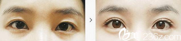 金鴻烈院長雙眼皮消失修復(fù)案例 金鴻烈院長雙眼皮消失修復(fù)案例