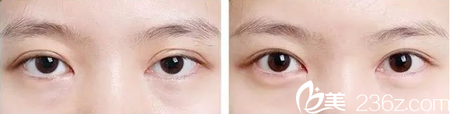 金鴻烈院長雙眼皮不對(duì)稱修復(fù)案例 金鴻烈院長雙眼皮不對(duì)稱修復(fù)案例