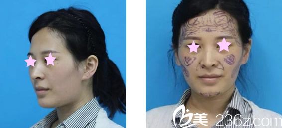 蘭州韓美整形自體脂肪填充全臉前 蘭州韓美整形自體脂肪填充全臉前