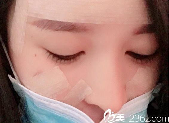 脂肪移植填充全臉天 脂肪移植填充全臉天