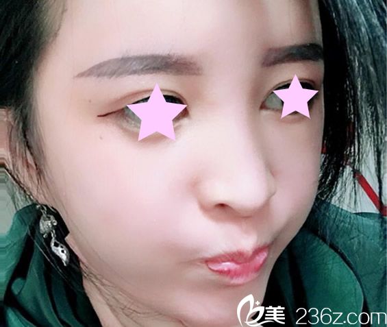 全臉脂肪填充15天后 全臉脂肪填充15天后