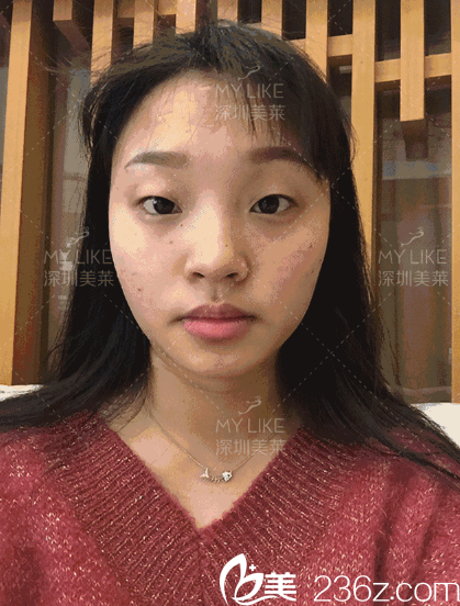 在深圳美萊做雙眼皮手術(shù)前 在深圳美萊做雙眼皮手術(shù)前