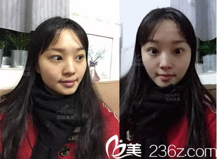 深圳美萊陳磊做的雙眼皮術(shù)后7天 深圳美萊陳磊做的雙眼皮術(shù)后7天