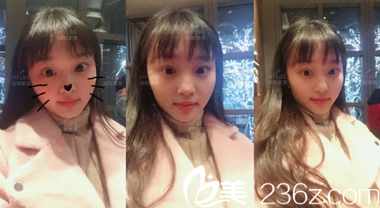 雙眼皮開眼角術(shù)后兩周圖片 雙眼皮開眼角術(shù)后兩周圖片