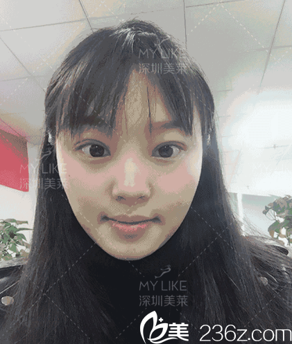 全切雙眼皮術(shù)后一個月照片 全切雙眼皮術(shù)后一個月照片